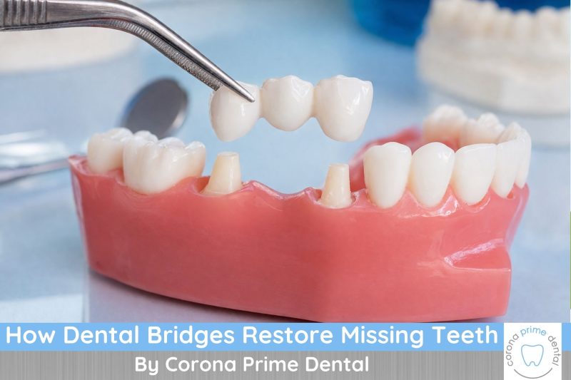 How Dental Bridges Restore Missing Teeth