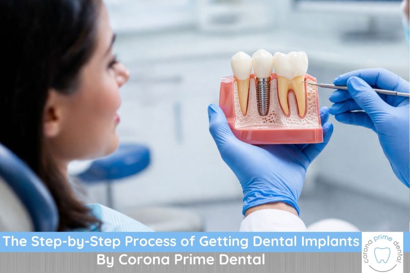 The Step-by-Step Process of Getting Dental Implants