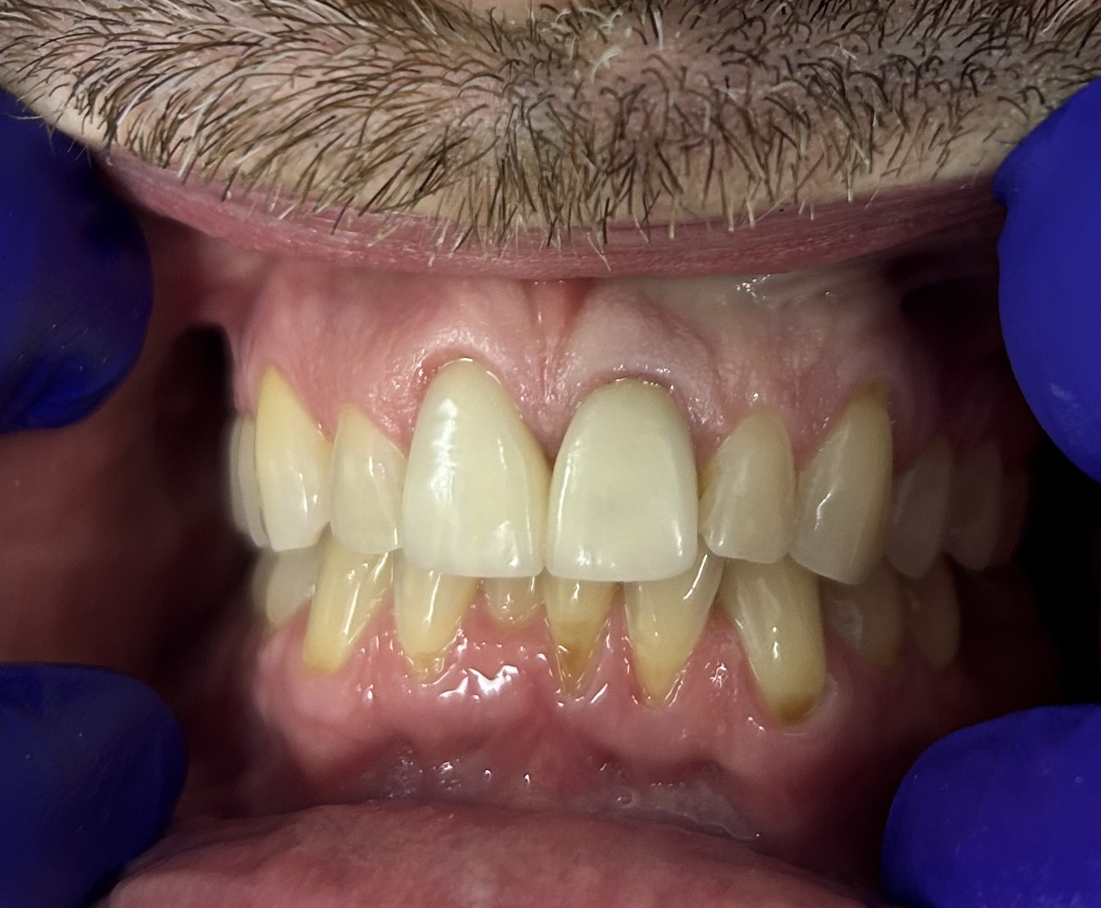 Patient 1 before dental treatment - view 3