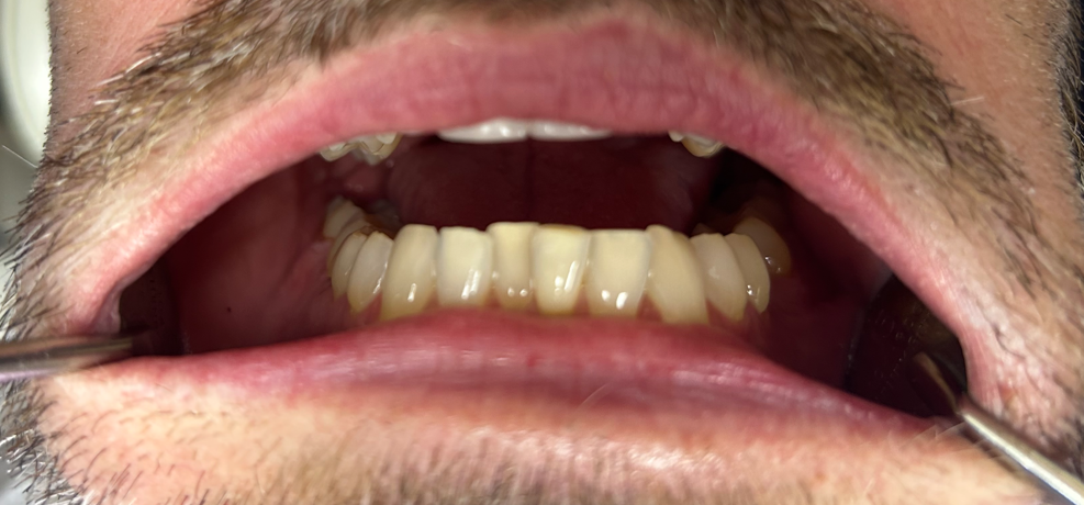 Patient 1 before dental treatment - view 2