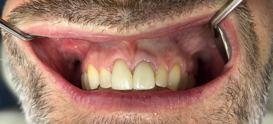 Patient 1 before dental treatment - view 1