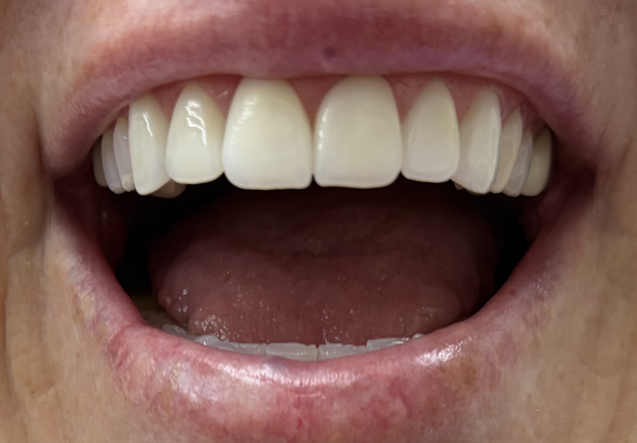 Patient 2 after dental treatment