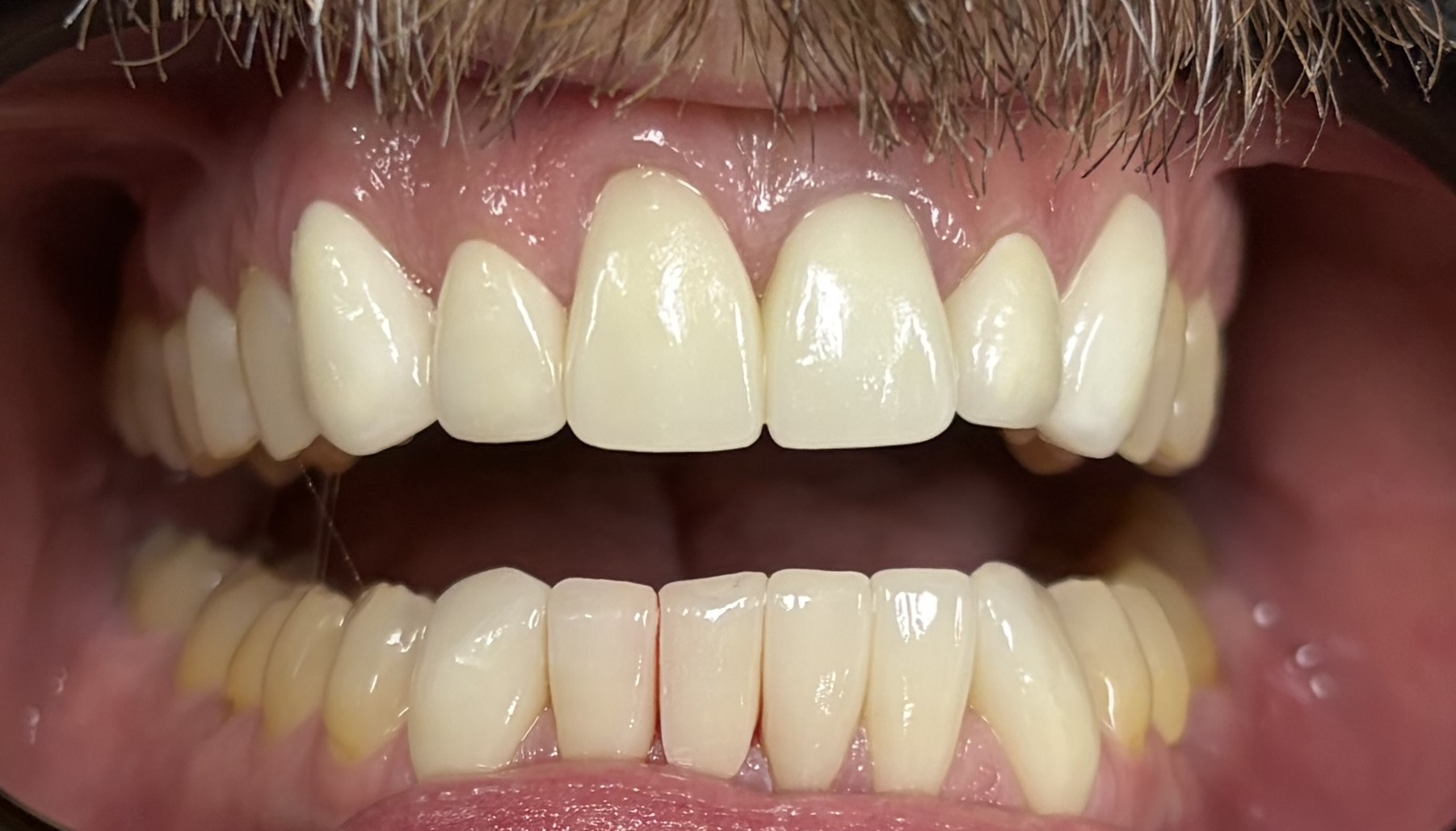 Patient 1 after dental treatment - view 2