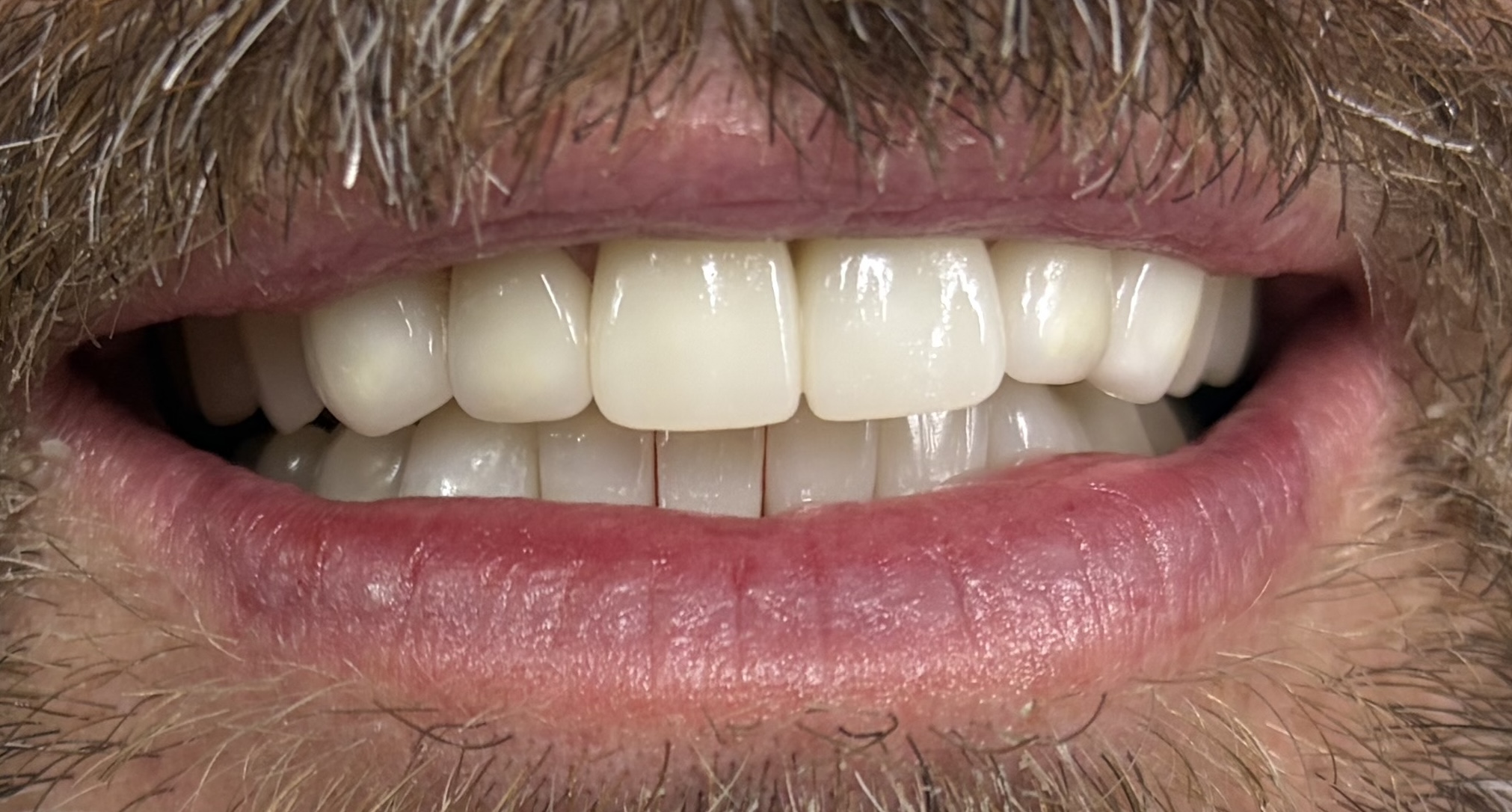 Patient 1 after dental treatment - view 1