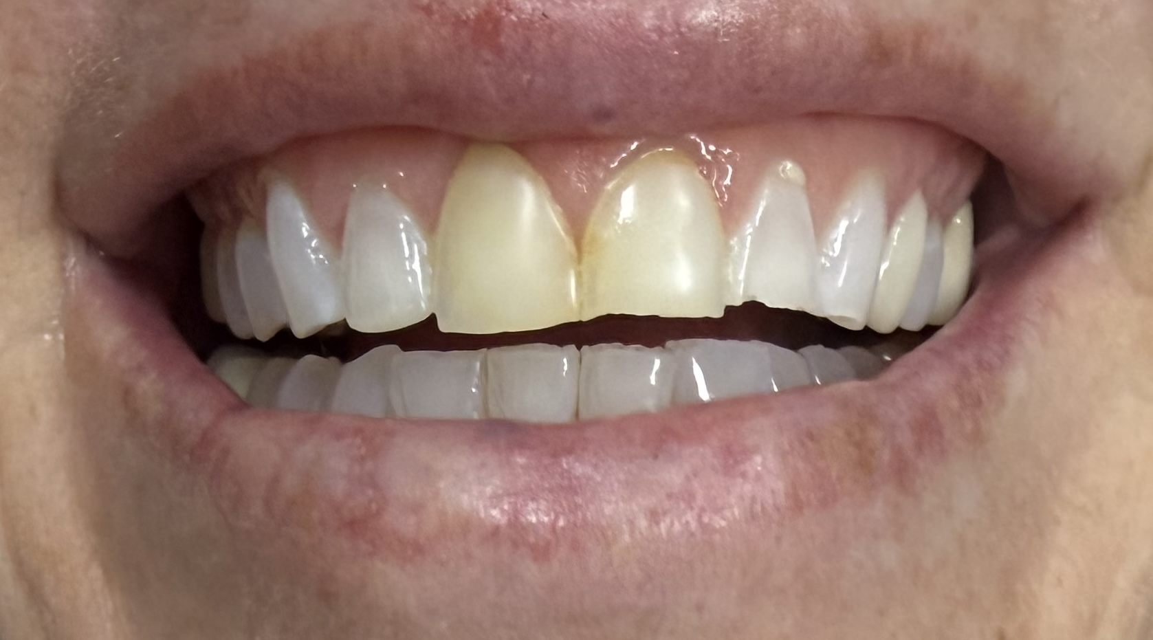 Patient 2 before dental treatment